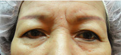 雙眼皮老化鬆弛下垂(Dermatochalasis)