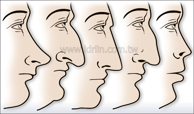 常見的隆鼻鼻型