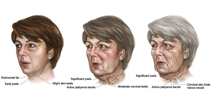 臉部老化下垂 - 拉皮