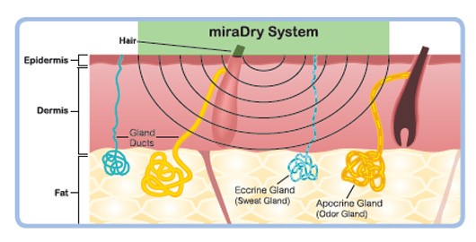 微波頻率維持5.8GHz，能量精準傳遞的目標為真皮與脂肪交接處(dermal-fat interface region) -汗腺分布的區域，與皮膚厚度無關