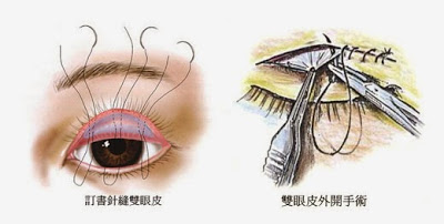 訂書針縫雙眼皮與割雙眼皮