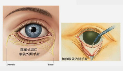 眼袋內開與割眼袋手術