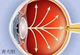 青光眼割雙眼皮會使眼壓增高