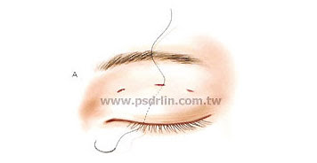 訂書針縫雙眼皮