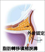 無痕眼袋內開補淚溝