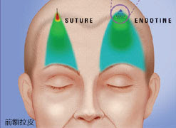 內視鏡前額拉皮手術