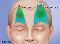 內視鏡五爪釘前額拉皮
