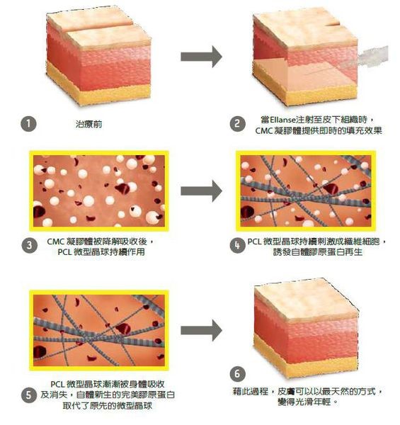 洢蓮絲, Ellanse, 依戀詩可刺激膠原蛋白增生