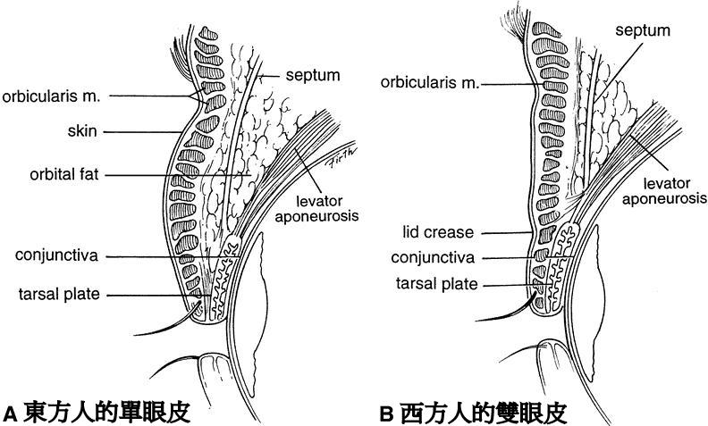 雙眼皮手術形成原理