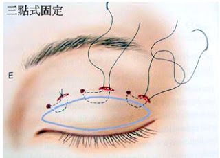 訂書針縫雙眼皮