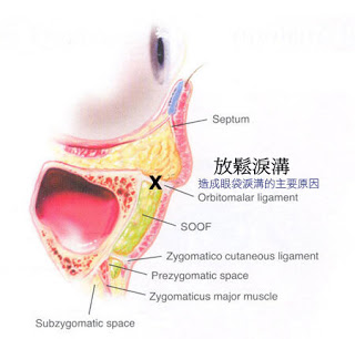 隱形眼袋外開補淚溝 = 隱形割眼袋+放鬆淚溝+脂肪回填補淚溝