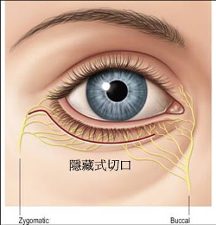 隱形眼袋外開補淚溝