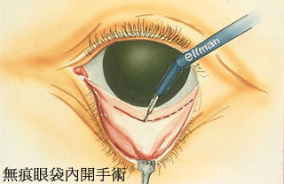 無痕眼袋內開