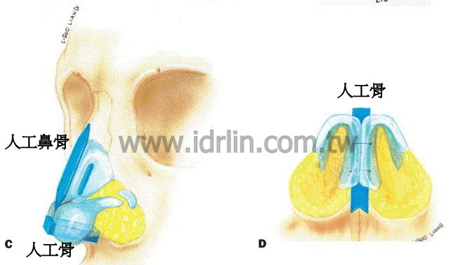 人工骨韓式隆鼻