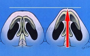 縮鼻翼是要讓鼻子仰角呈現的鈍角三角形變成正三角形