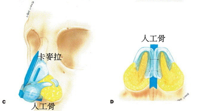 人工骨韓式隆鼻