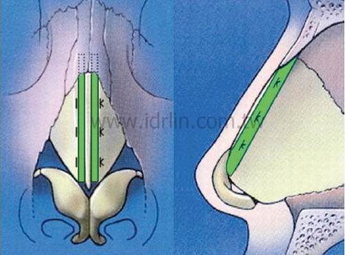 擴展移植, spreader graft