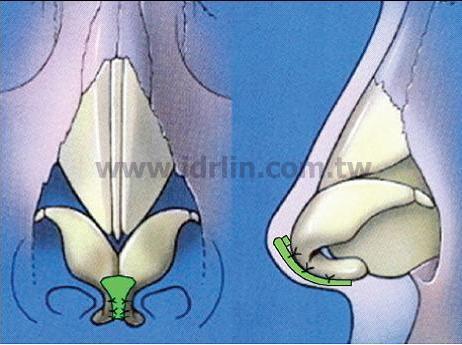 延伸盾牌移植(Extended Shield Graft)