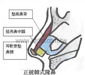 韓式隆鼻