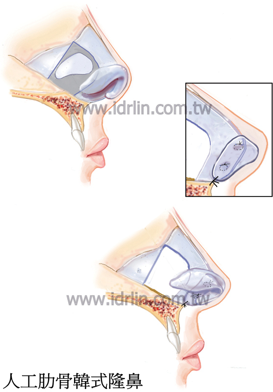 人工肋骨韓式隆鼻