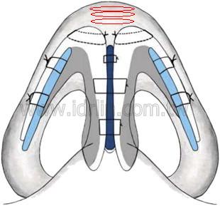 將鼻頭軟骨兩兩對縫後，在墊上耳朵軟骨，就可以縮小鼻頭，最多縮小1/2