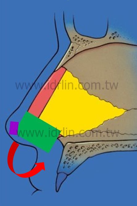以人工肋骨和鼻中膈軟骨做ESG韓式隆鼻容易有鼻頭下垂的問題