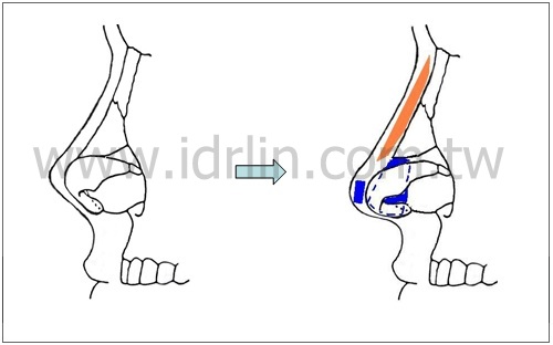 馬鞍鼻-韓式隆鼻作法