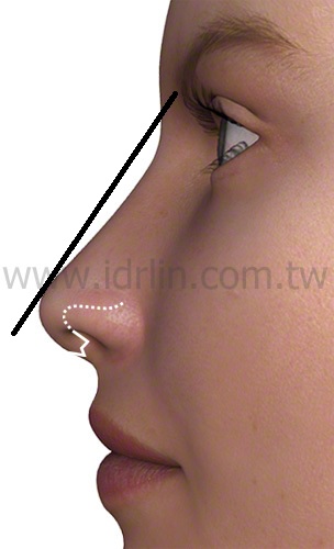 微翹的鼻頭會略高於鼻樑約2mm, 是好看精緻的鼻頭