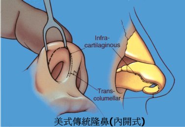 傳統美式隆鼻