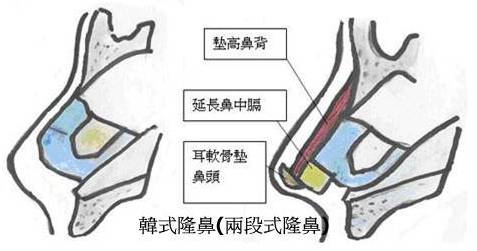 韓式隆鼻