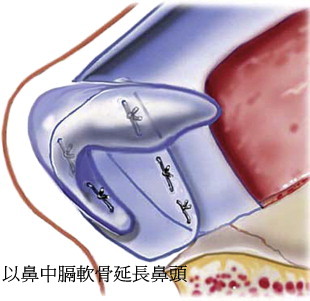 韓式隆鼻以鼻中膈軟骨延長鼻頭