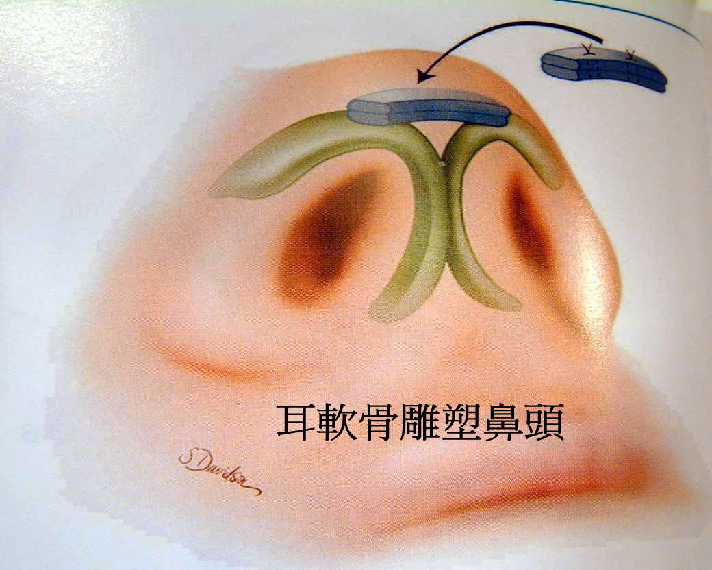 韓式隆鼻以耳朵軟骨雕塑鼻頭