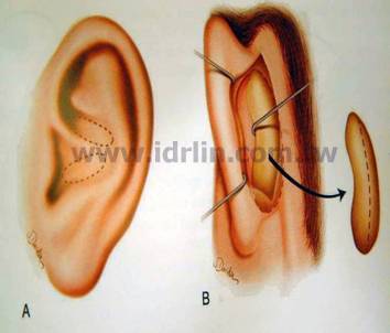 韓式隆鼻 - 取耳朵軟骨