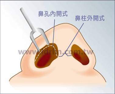 韓式隆鼻 - 自鼻中柱處作W字形的切開，再行雙側鼻內側切開