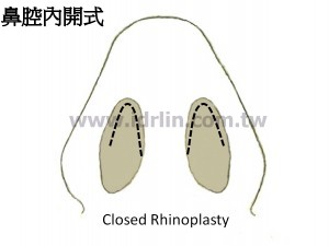 內開式隆鼻