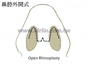 外開式隆鼻