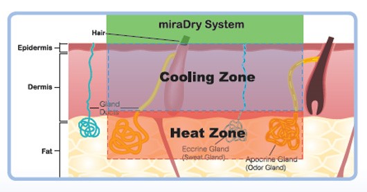 能量治療溫度維持60℃，使汗腺萎縮不再新生，維持持續性效果。