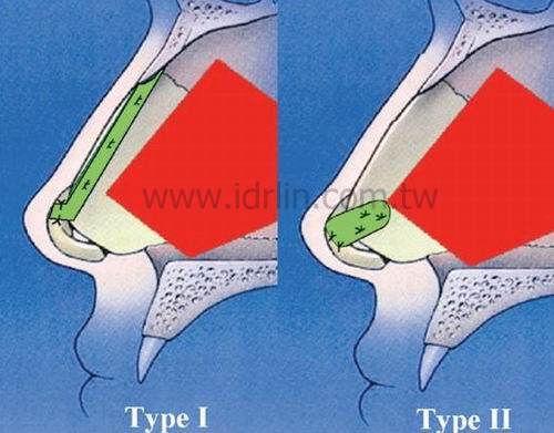 鼻中隔延長移植 Extension Septal Grafts, ESG