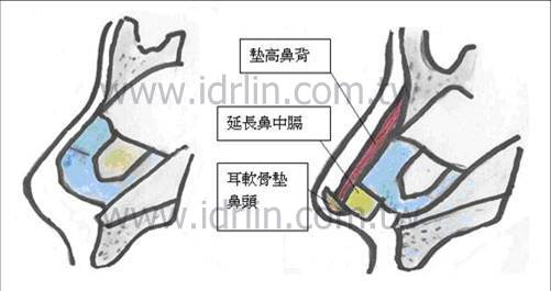 林敬鈞醫師 韓式隆鼻