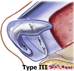 Extension Septal Grafts, ESG