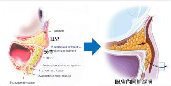 複合式眼袋內開手術