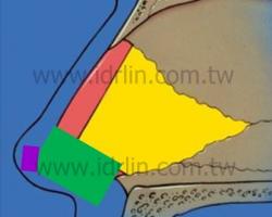 以人工骨做ESG韓式隆鼻可改善鼻頭下垂的問題